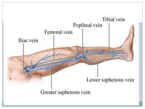 Dvt Deep Vein Thrombosis Ppt Free Download