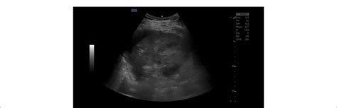 Ultrasound Image In Left Hypochondrium A Large Mixed Echogenicity