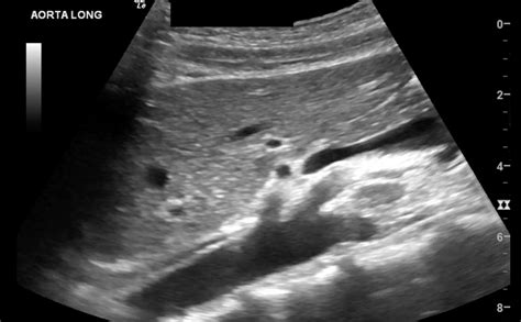 Sonography Abdominal Vascular Assessment Protocols And Interpretation Article