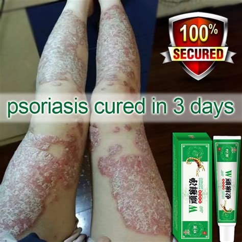 Jual Cod Ekzema Cream Krim Kudis Kurap Panau Ruam Dll Psiorasis Fungus