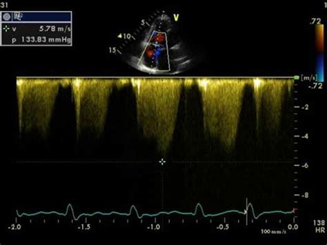 Transthoracic Echocardiography Apical Four Chamber View Continuous