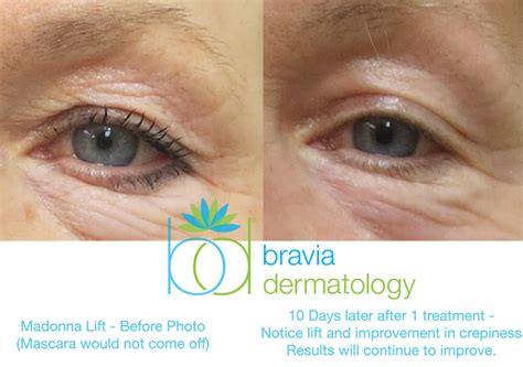 Fractional Co Laser Resurfacing Toledo Oh Bravia Derm