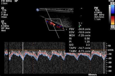 Pulsatile Flow Automated Measurements Of Various Parameters Download Scientific Diagram