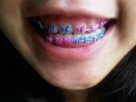 14 best images about CUTE BRACES COLOR ️ on Pinterest | Glow, Irish flags and Colors