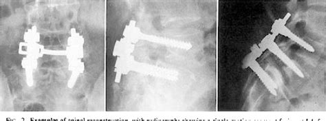 Figure From Transpedicular Screw Rod Fixation Of The Lumbar Spine