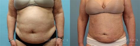 Stomach Liposuction Before And After Women