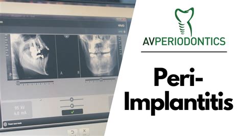 Peri Implantitis Manhattan Ny Dr Alexander Volchonok Youtube