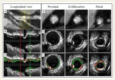 Bifurcation Matching And Analysis By Mdct And Ivus Vh To Ensure Download Scientific Diagram