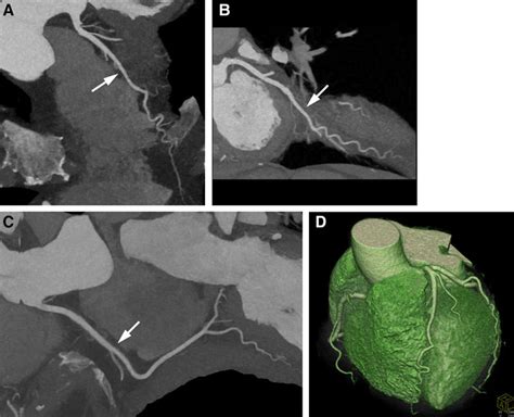 Can Coronary Computed Tomography Angiography Replace Invasive