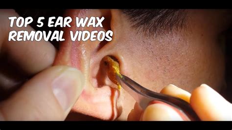 Top Ear Wax Removal Videos Very Satisfying Youtube