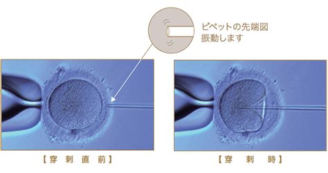 体外受精・顕微授精｜生殖医療科 杉山産婦人科