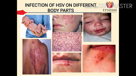 Pathology Of Herpes Simplex Virus Infection YouTube