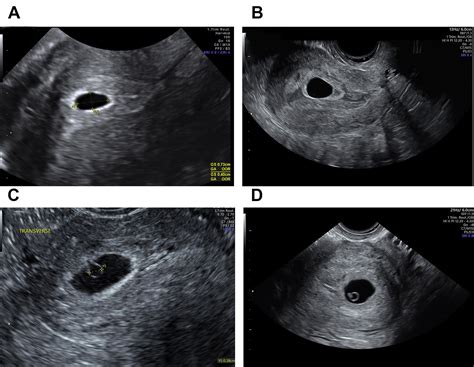 Ultrasound In Early Pregnancy Obstetrics And Gynecology Clinics