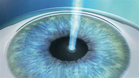 PRK/LASEK Experts - lasik-info.com - All about LASIK, Femto-LASIK ...