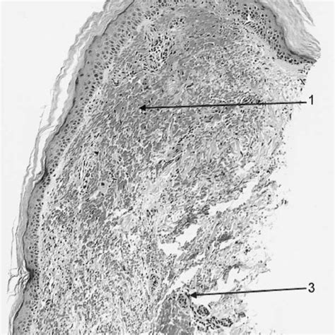 Medium Power Microscopic View Of A Punch Biopsy Skin Specimen Showing