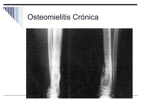 Osteomielitis