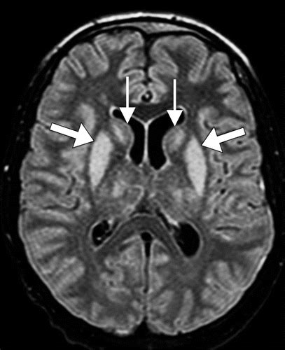 Imaging Of Creutzfeldt Jakob Disease Imaging Patterns And Their