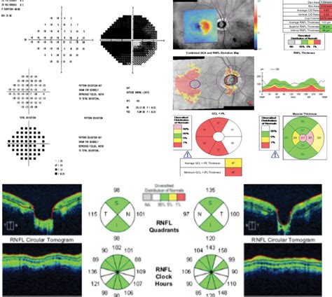 Lesson Visual Fields In The Era Of Oct