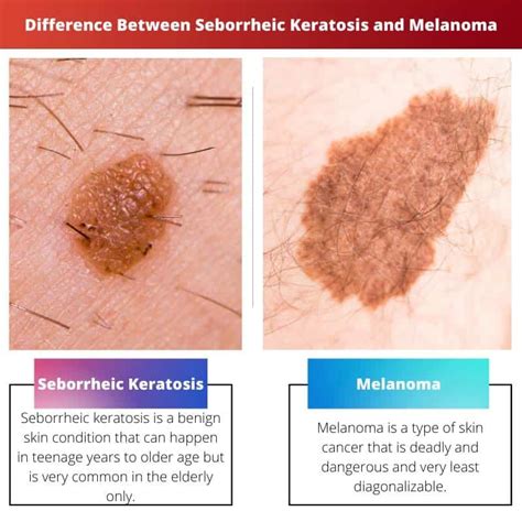 Seborrheic Keratosis Vs Melanoma Difference And Comparison