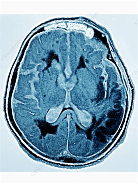 Stroke, Left Hemisphere of Brain - Stock Image - C027/2324 - Science Photo Library