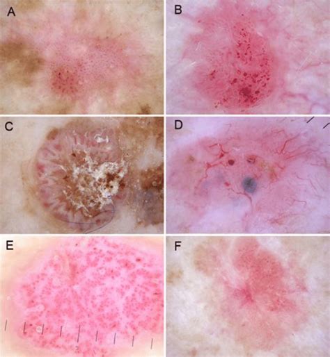 Six Lesions With Six Different Vascular Patterns A A Lesion With A Download Scientific