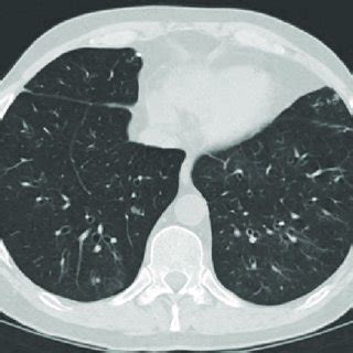 Chest Computed Tomography In A Lung Transplant Recipient With