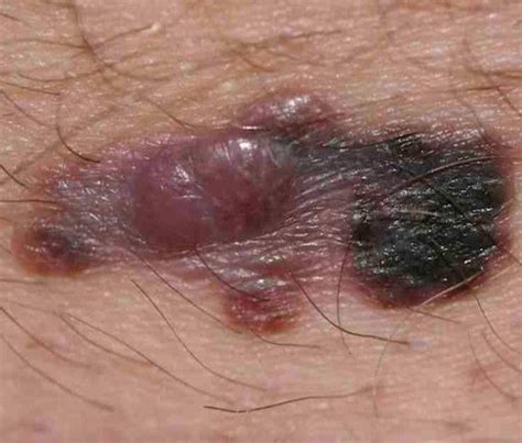 Nodular Melanoma