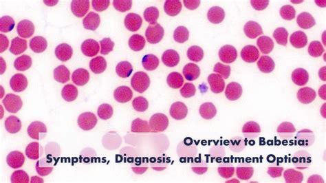 Overview To Babesia Symptoms Diagnosis And Treatment Options — Lyme Advise