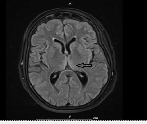 FLAIR MRI medial thalamic hyperintensities FLAIR MRI of the brain shows... | Download Scientific ...