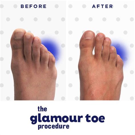 Bunion Surgery Results Gallery Before After Photos Be Bunion Free