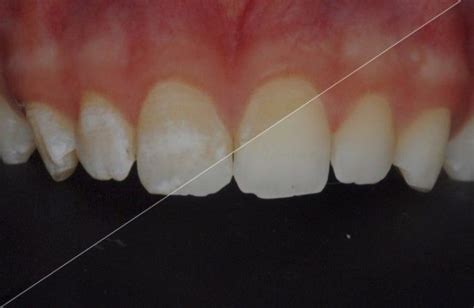 Conservative Treatment Of Fluorosis And Post Orthodontic White Spots