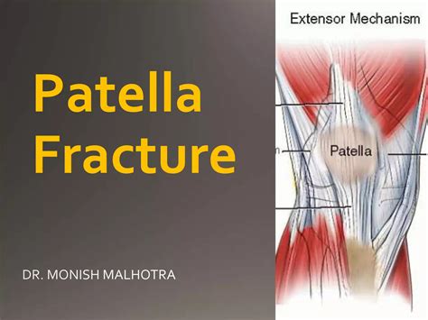 Patella fracture | PPT