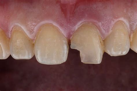 What Can Happen If You Dont Treat A Chipped Tooth