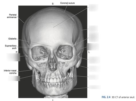 Diagram Of 3D CT Anterior Skull Quizlet