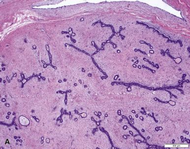 Breast Histology And Pathology Flashcards Quizlet