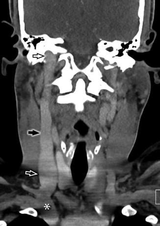 Jugular Vein Thrombosis | Radiology Key