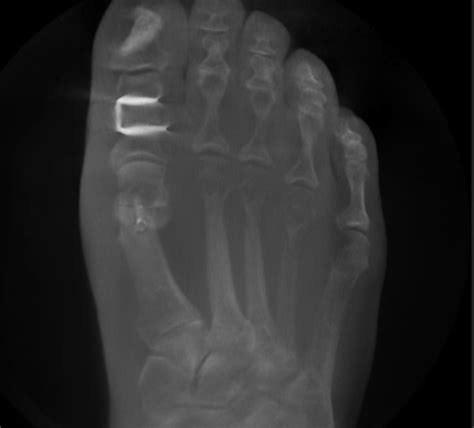 R Ntgen Und Mrt Bei Hallux Valgus Welche Bildgebung Brauche Ich