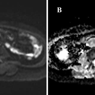 This Mass Has High Signal Intensity On Dwi A And Low Adc Values B