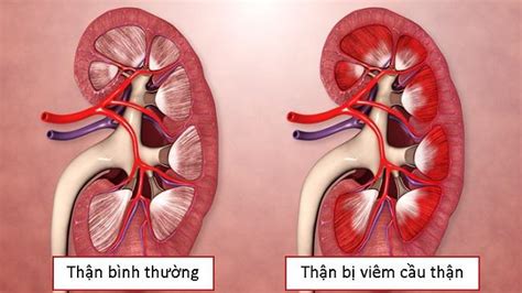 Biết ngay dấu hiệu của bệnh viêm cầu thận để phòng tránh căn bệnh đáng