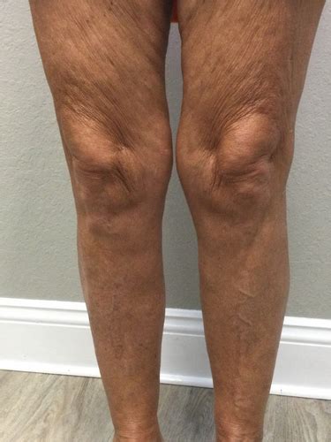 Before After Fort Myers Vein Specialists