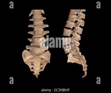 Collection Of Ct Lumbar Or L S Spine D Rendering Image Front Back