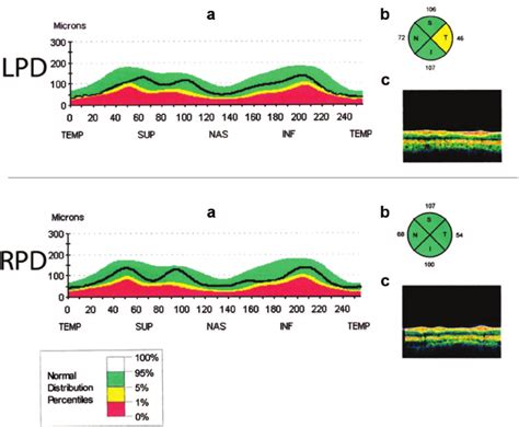 Retinal Nerve Fiber Layer Rnfl Depictions Selected Elements Of An Download Scientific