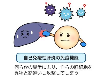 自己免疫性肝炎 (じこめんえきせいかんえん)とは | 済生会
