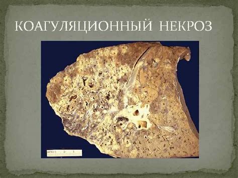 НЕКРОЗ Некроз это гибель клеток