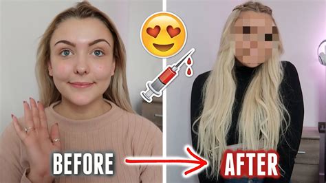 The Ultimate Glow Up Transformation Video I Got Lots Of Filler Youtube