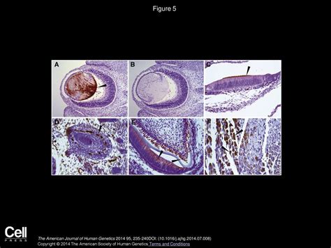 Exome Sequencing Identifies A Recurrent De Novo Zswim Mutation