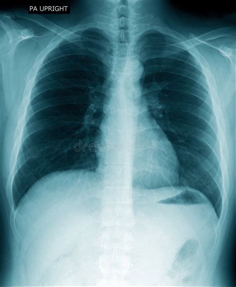 Secre O No Pulm O Foto De Stock Imagem De Raio Radiologia