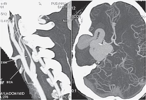 Figure 1 From Endovascular Treatment In An Unusual Case Of Direct Carotid Cavernous Fistula