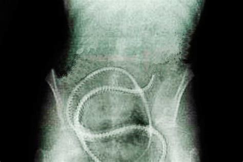 Larvas De Solitaria Nuevo Tratamiento Contra C Ncer De Colon