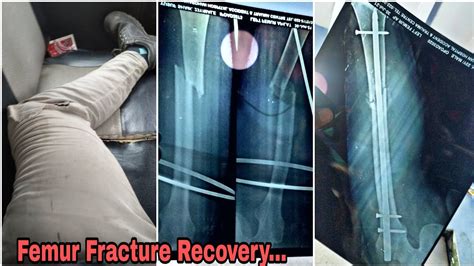 Femur Fracture Recovery Femoral Shaft Fracture Month Recovery